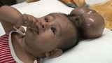 Phẫu thuật thành công em bé có đầu “sinh đôi“